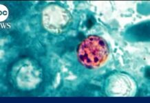 Silent Parasite Rips Michigan — What’s Contaminated? Health alert about cyclosporiasis parasitic infection